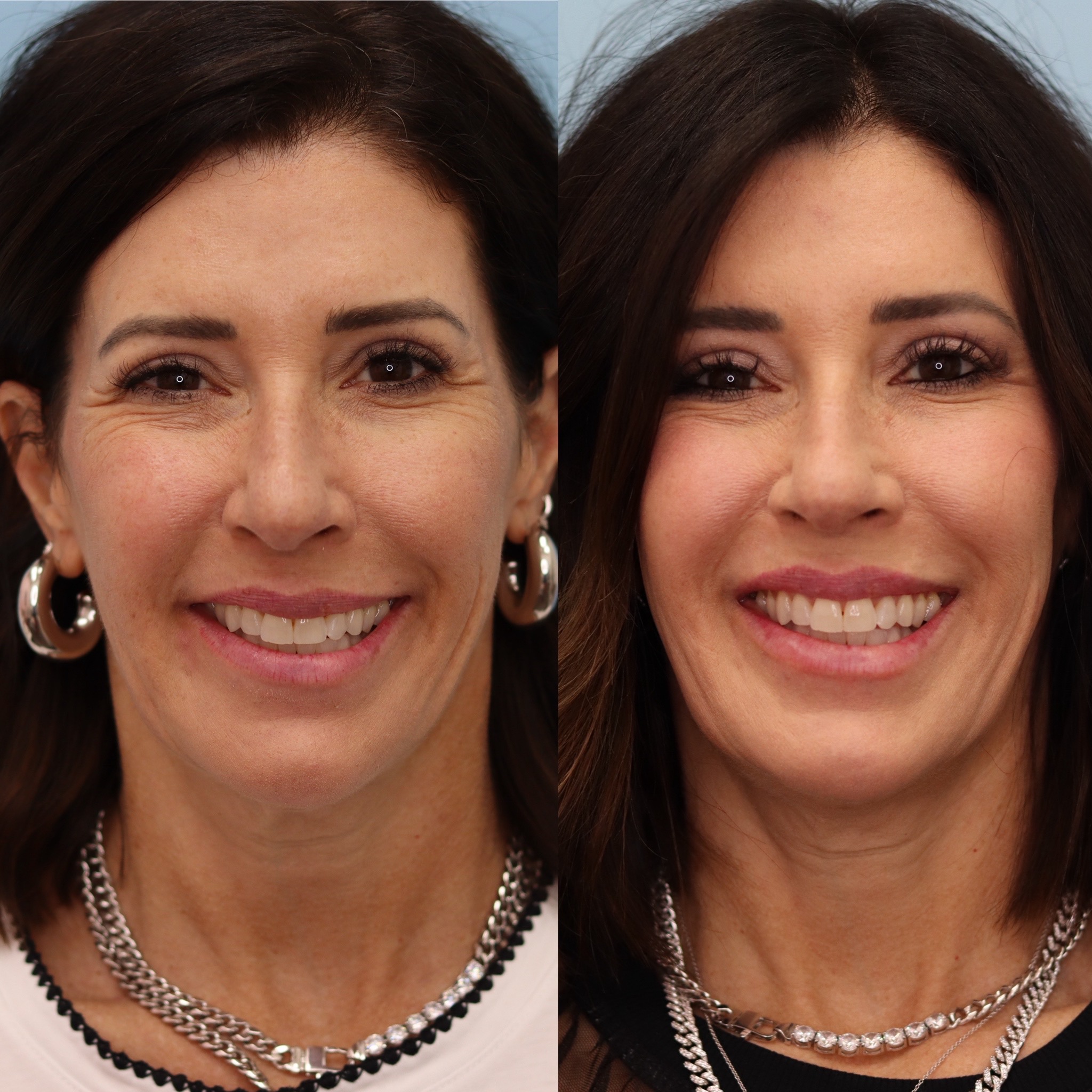 Botox/Tox — Before & After