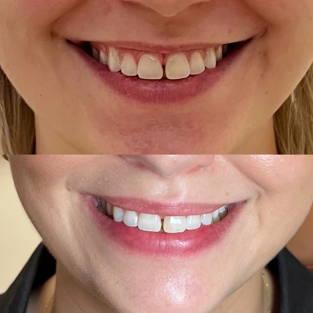 Lip Flip — Before & After
