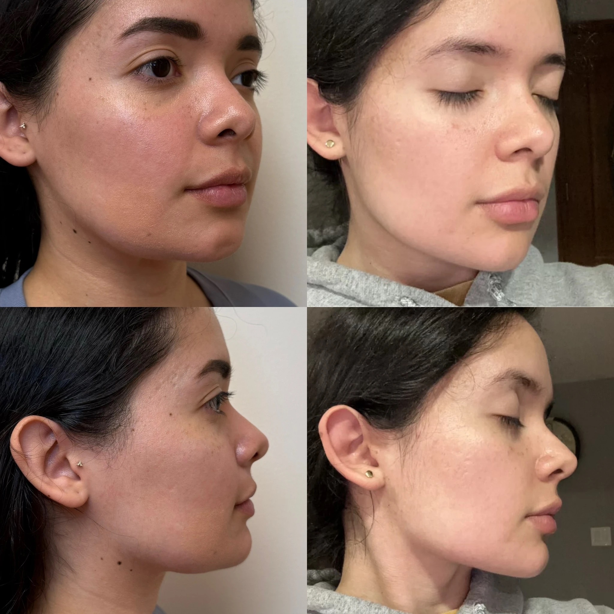 Filler — Before & After
