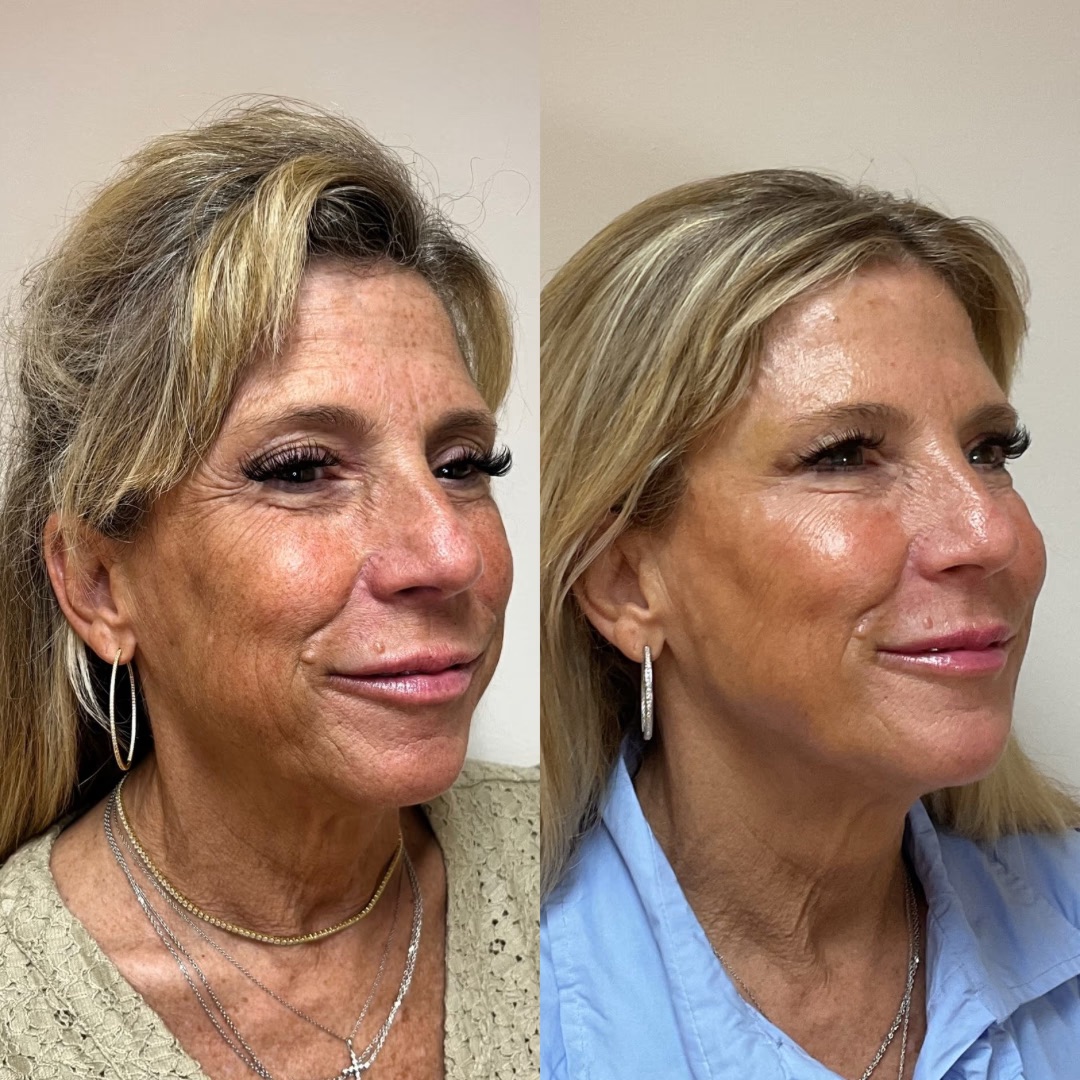 Filler — Before & After