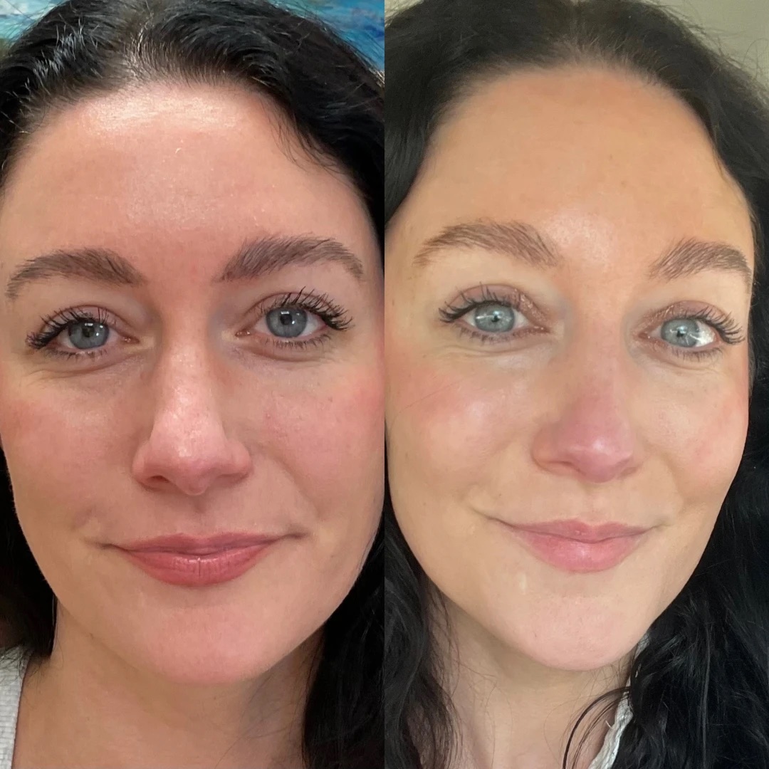 Botox/Tox — Before & After