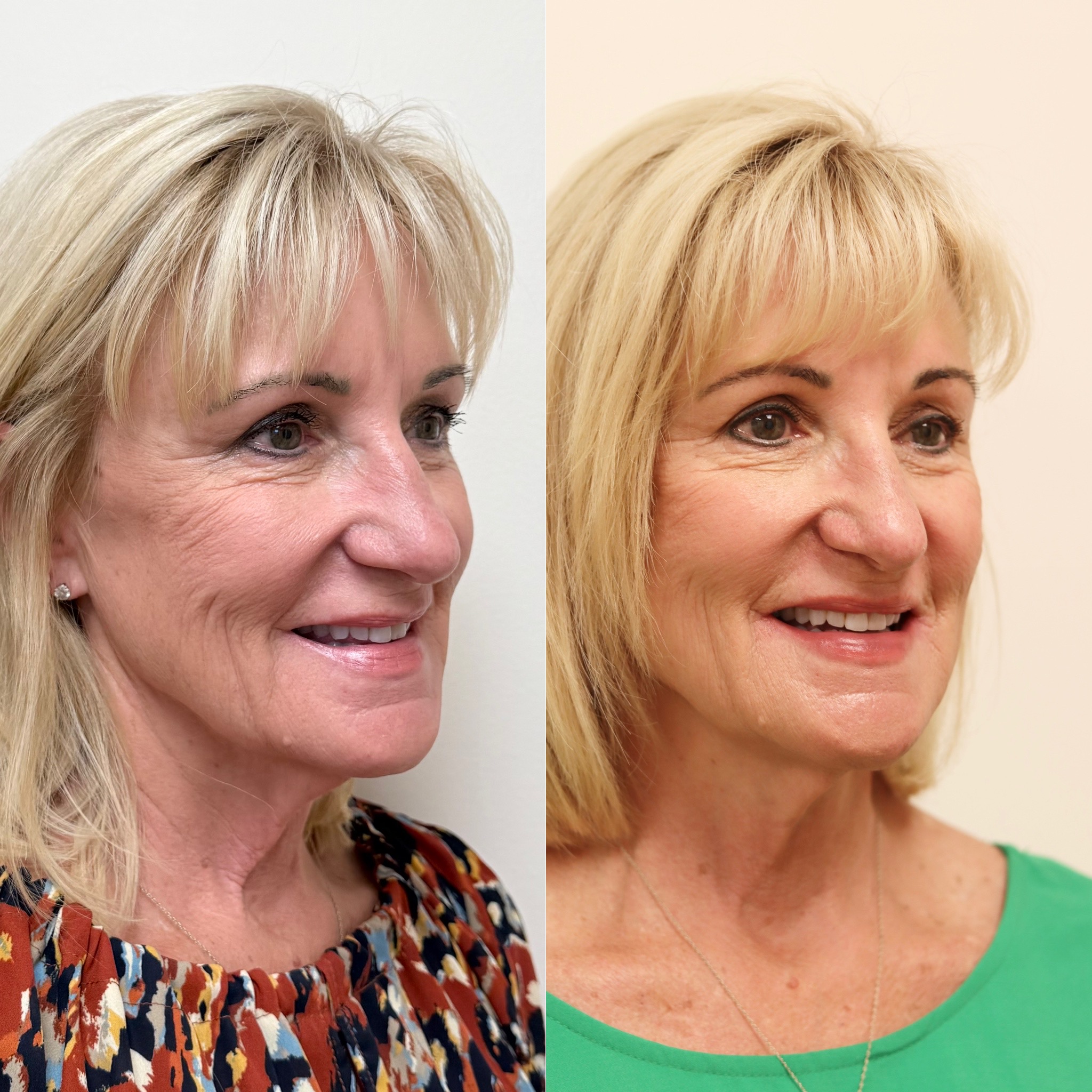 Sculptra — Before & After